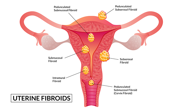 Uterine Fibroids