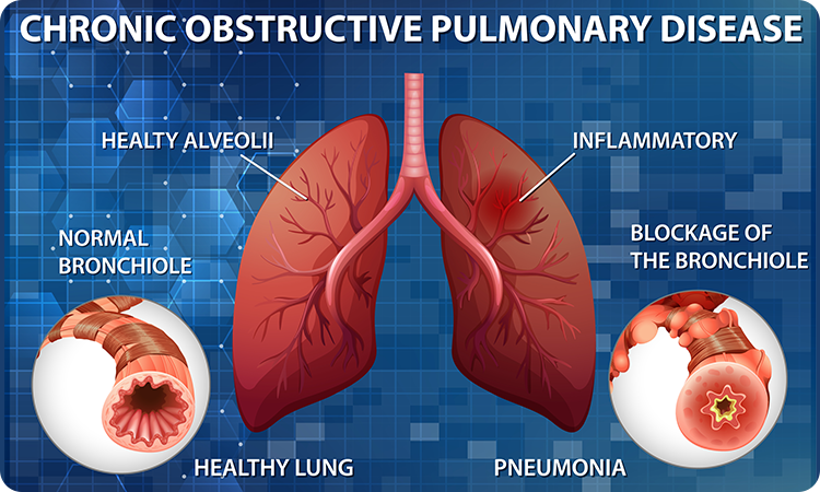 COPD ( Chronic Obstructive Pulmonary Disease )