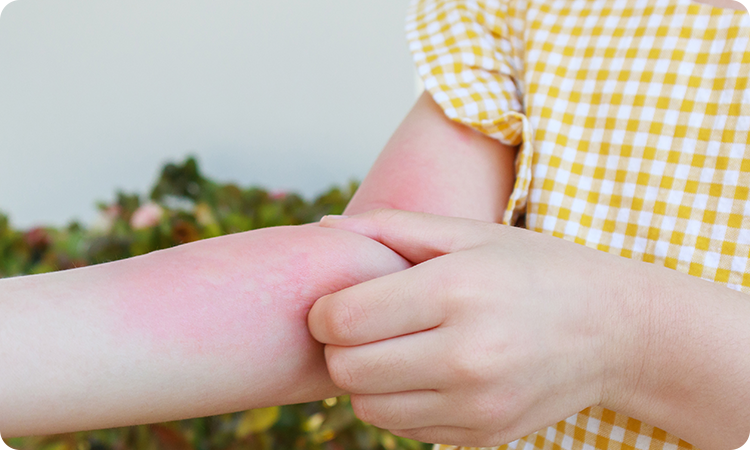 Urticaria or Hives