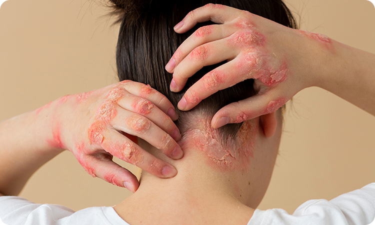 Atopic Eczema and Contact Allergic Dermatitis