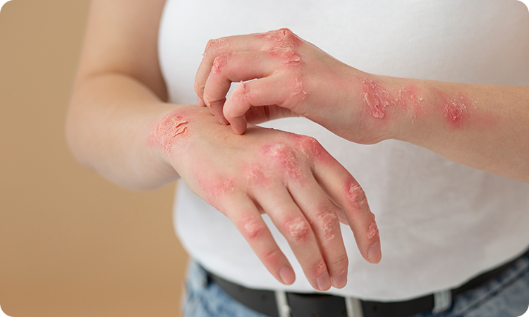 Seborrhoeic Dermatitis