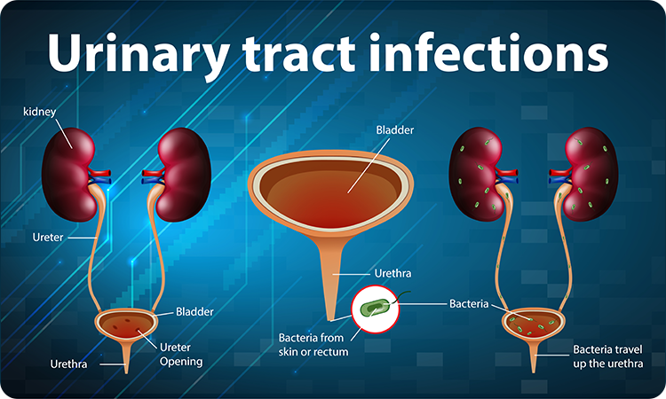 Urinary Tract Infection