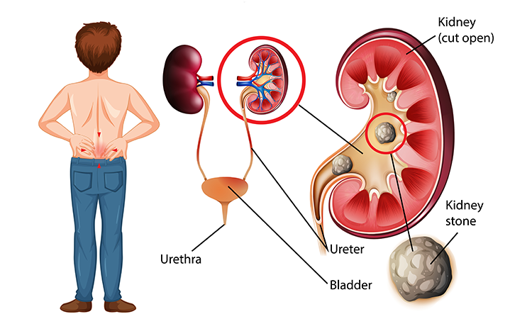 Kidney Stones