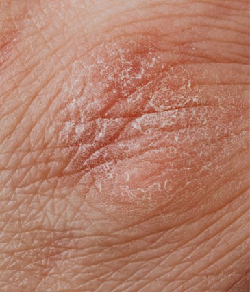 Skin Diseases